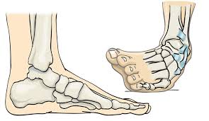 esguince de tobillo